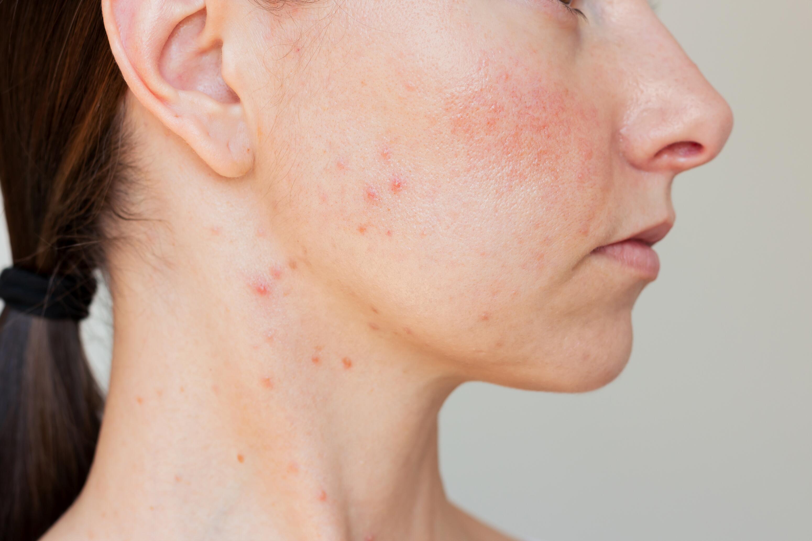 Acne spots on the neck